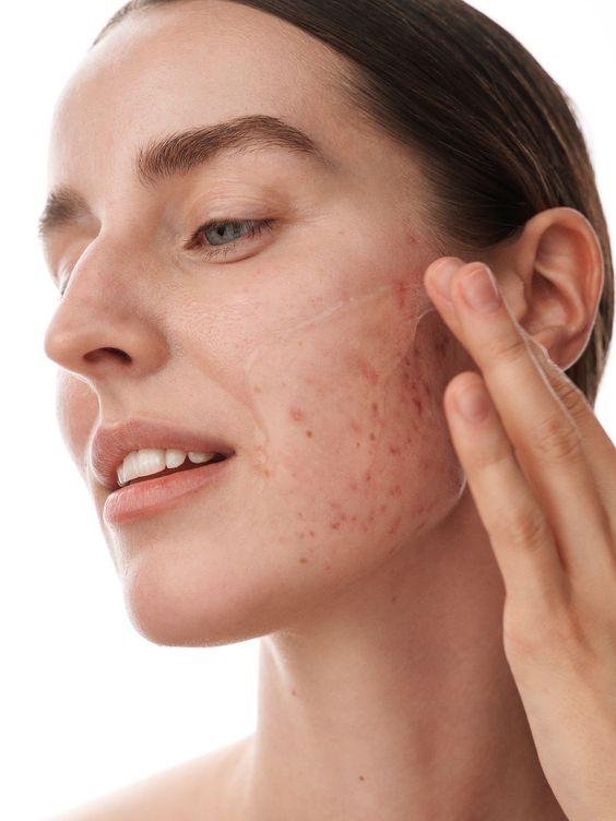 Glowing Skin Ahead: Unveiling the Effectiveness of LED Light Therapy for Acne